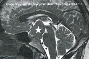 George Helon Hypothalamic Hamartoma